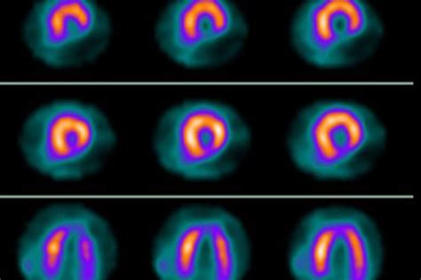 Image result for Nuclear Heart Stress Test