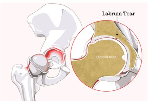 Right Hip Labrum に対する画像結果