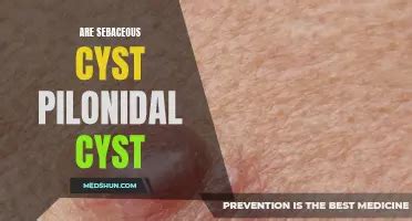 Image result for Lancing a Sebaceous Cyst