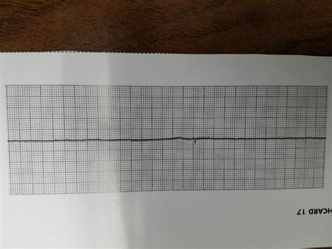EKG Practice Test Quizlet に対する画像結果