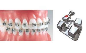 Image result for Ortho Spots Brackets