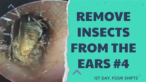 Toradh íomhá ar Bug Stuck in Ear