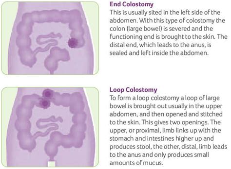 Image result for Types of Colostomy