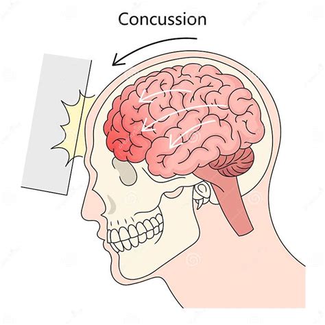 Toradh íomhá ar Concussion and Impact On Your Health