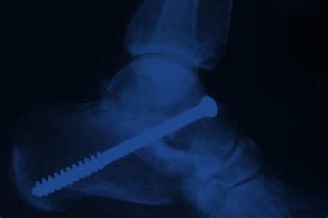 Image result for Subtalar Joint Flexion