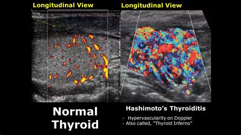 Toradh íomhá ar How to Dointussusception Ultrasound