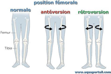 Image result for Femoral Retroversion Angle