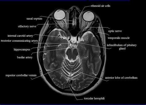 Image result for Normal MRI Axial View