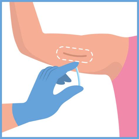 Toradh íomhá ar Nexplanon Animated Image