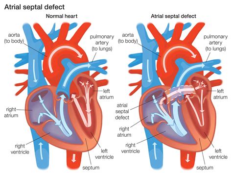 Toradh íomhá ar Ruis Atrium Septum Defect