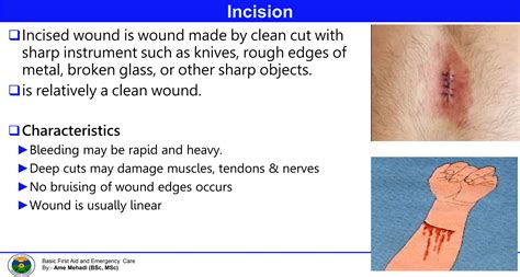 Image result for Open Wounds and Bleeding Types