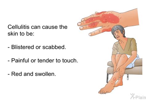 PatEdu.com : Cellulitis