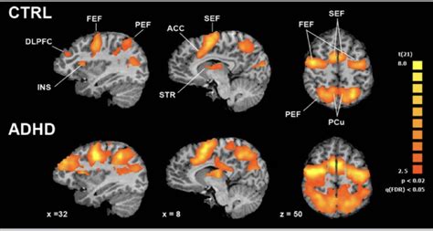 Image result for Prefrontal Cortex Brain Scan