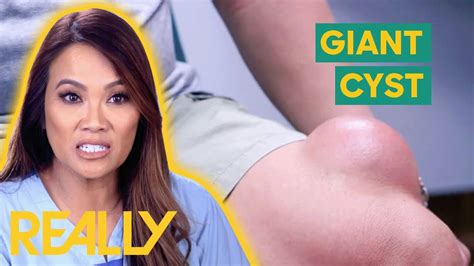 Toradh íomhá ar Exploding Cysts Newest