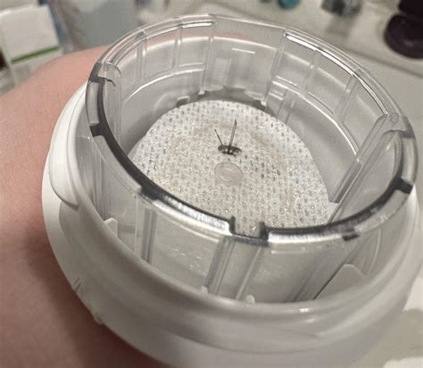 Afbeeldingsresultaten voor Dexcom Sensor Placement