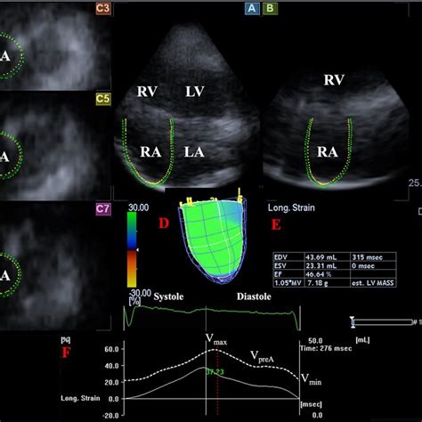 Toradh íomhá ar Speckle Tracking Algorithm