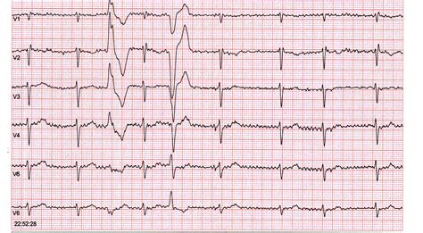 Image result for EKG Practice Test