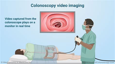 Image result for Colonoscopy Test Kit