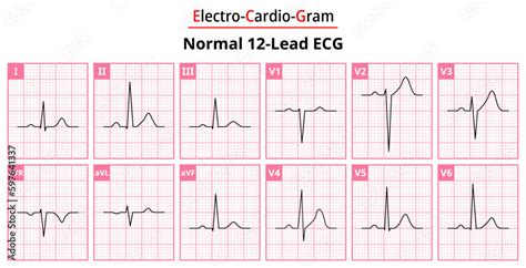Image result for Normal ECG Wave Pattern