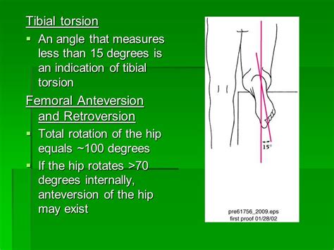 Toradh íomhá ar Femoral Anteversion vs Retroversion