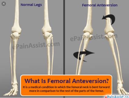 Toradh íomhá ar Femoral Anteversion vs Retroversion