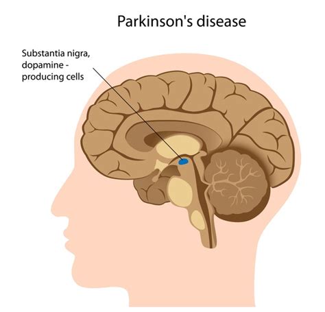 Image result for Sequence Diagram for Parkinson Disease