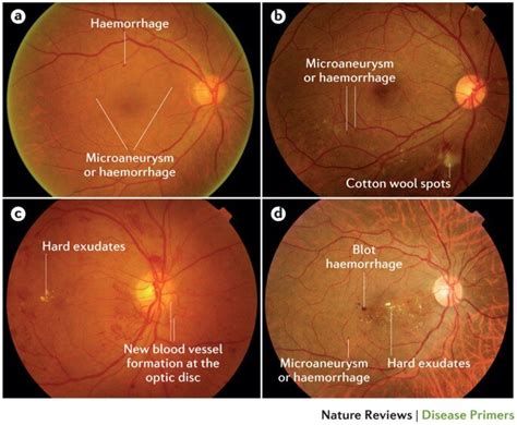 Toradh íomhá ar Fundoscopic Exam Diabetic Retinopathy