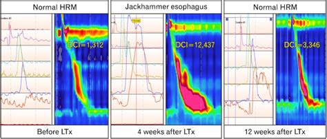 Toradh íomhá ar Conventional Manometry vs High Resolution Manometry