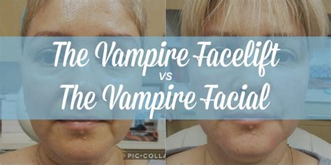 Image result for What Is a Vampire Facelift