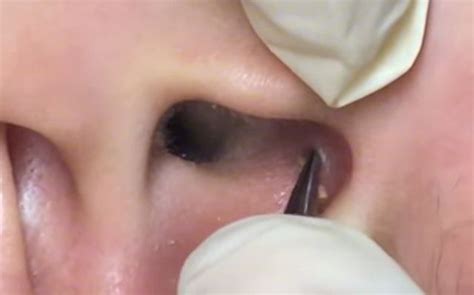 Gross Exploding Ear Pimple എന്നതിനുള്ള ഇമേജ് ഫലം