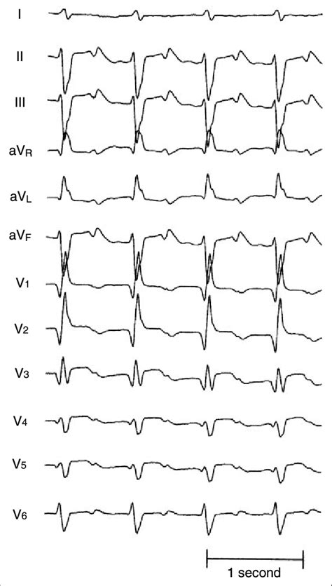 Afbeeldingsresultaten voor ECG Study