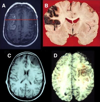 Image result for Prefrontal Cortex Brain Scan