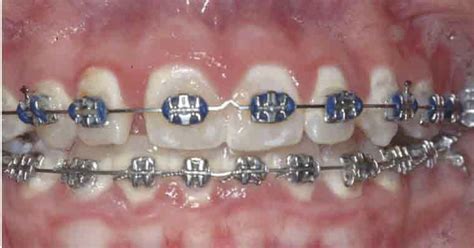 Image result for Ortho Spots Brackets