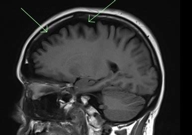 Afbeeldingsresultaten voor Frontal Cortex MRI Normal Side View