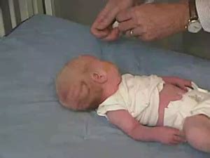 Toradh íomhá ar Abnormal Head Circumference