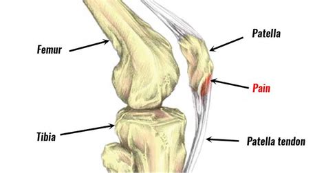 Snapping Lateral Hamstring に対する画像結果