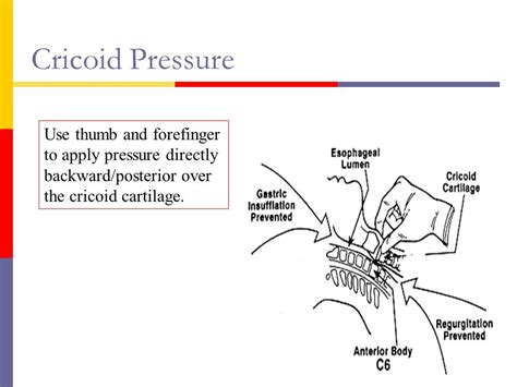 How to Apply Cricoid Pressure for Intubation に対する画像結果