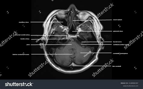 Normal Brain Anatomy Axial T1weighted Mri Stock Photo 2148990397 ...