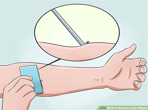 Image result for How to Remove a Bee Stinger