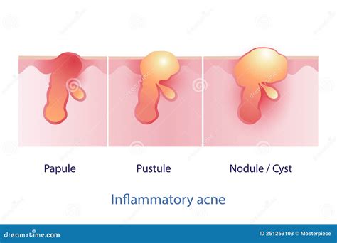 Inside Nodule Acne に対する画像結果