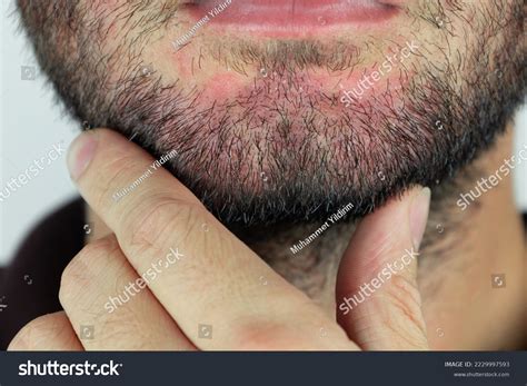 Rhus Dermatitis Face-এর ছবি ফলাফল