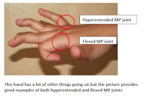 Toradh íomhá ar Digit Widget Finger