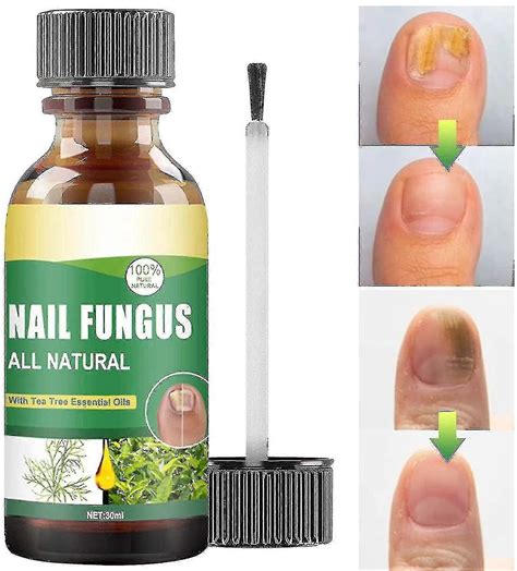 30Ml Toenail Fungus Treatment, Tea Tree Oil For Toenail Fungus, Antifungal Nail Solution Care Essence