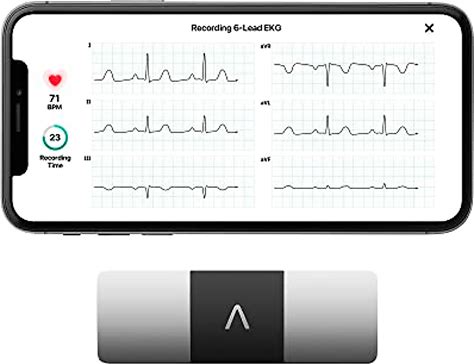 Kardiamobile 6-Lead Personal EKG Monitor - Six Views Of The Heart - Detects Afib And Irregular Arrhythmias - Instant Results In 30 Seconds - Works With Most Smartphones - FSA/HSA Eligible