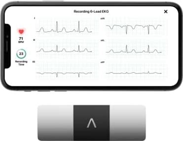 Kardiamobile 6-Lead Personal EKG Monitor - Six Views Of The Heart - Detects Afib And Irregular Arrhythmias - Instant Results In 30 Seconds - Works With Most Smartphones - FSA/HSA Eligible