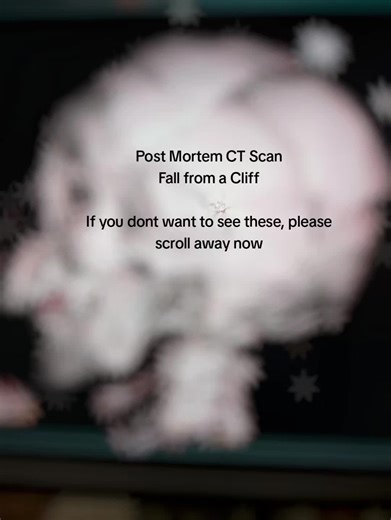 Does your facility do Post Mortem CT scans? Do you feel it's necessary or waste of resources? #postmortem #ctscan #radiology #xray #cttech Image Credit: Reddit