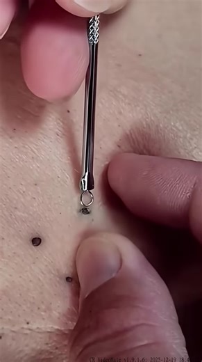 Effective Pimple Popping Techniques for Clear Skin