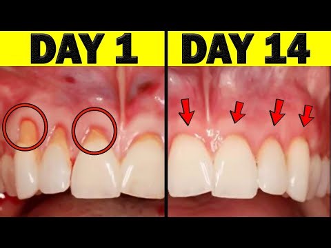 How to Treat Gum Disease at Home EFFECTIVELY