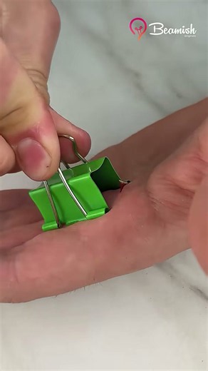 Simple splinter removal method #quick #easy #splinter #trick