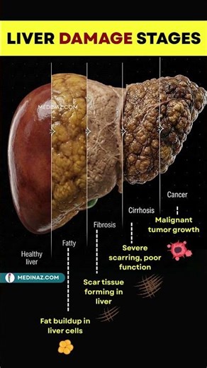 How Liver Disease Develops Over Time — Stage by Stage | Fatty Liver | Liver Cirrhosis